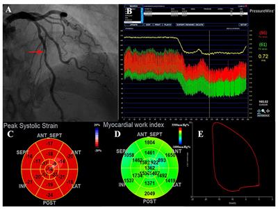 Regional Myocardial Work Measured by Echocardiography for the Detection of Myocardial Ischemic Segments: A Comparative Study With Invasive Fractional Flow Reserve